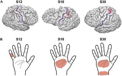 Functional Frequency Discrimination From Cortical Somatosensory Stimulation in Humans